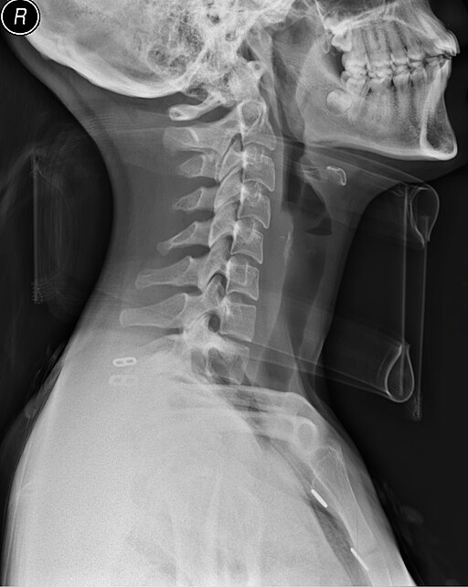 Accidente + lesiones ≠ causalidad [STS]